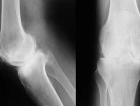 骨质疏松与骨关节炎区别有哪些