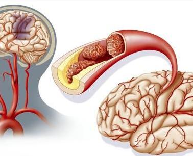 脑血栓早期的症状:突然发生眩晕:眩晕是脑血栓的前兆中极为常见的症状