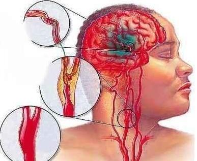 脑血栓前兆做什么检查