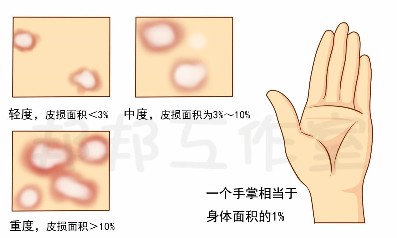 寻常型银屑病的诊治与护理