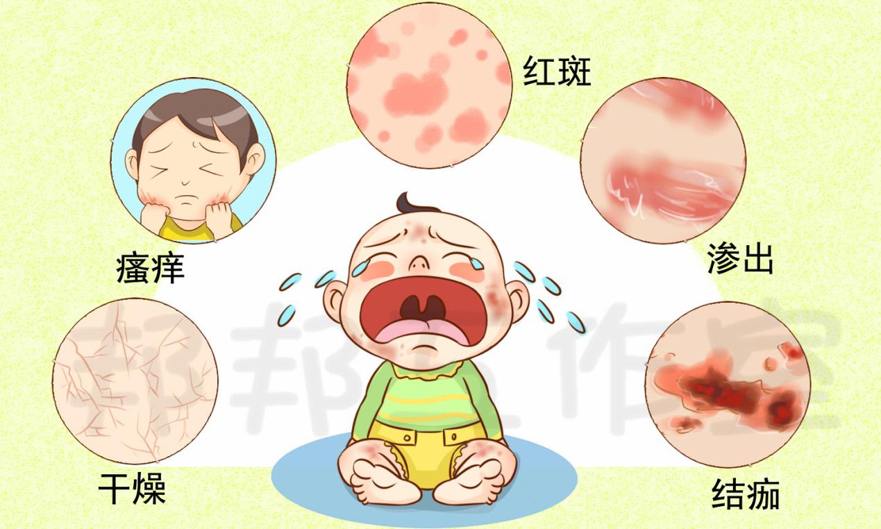 婴儿湿疹常见的六大误区,你踩雷了吗