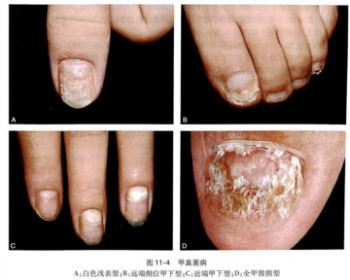 灰指甲治疗费用是多少？如果治疗更好呢？