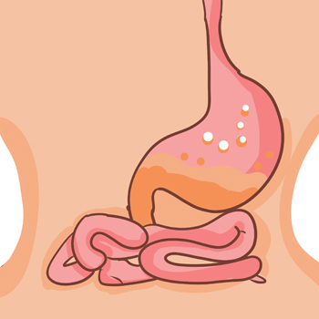 胃食管反流症状及表现是什么？要如何应对？