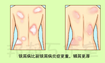 银屑病与副银屑病一字之差，哪种对人体危害大？