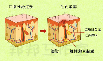 别不拿痤疮当病，小心留疤！