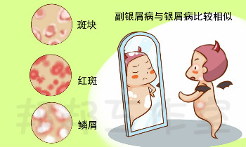 银屑病与副银屑病一字之差，哪种对人体危害大？