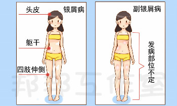 银屑病与副银屑病一字之差，哪种对人体危害大？