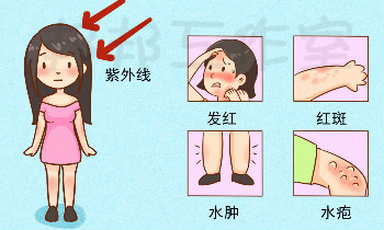太阳一晒皮肤就发痒，日光性皮炎怎么办？