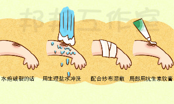 太阳一晒皮肤就发痒，日光性皮炎怎么办？