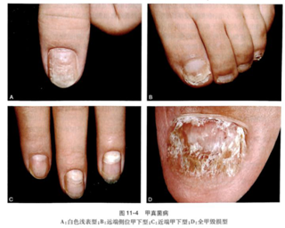 灰指甲治不好有危害吗？怎样才能治好灰指甲？