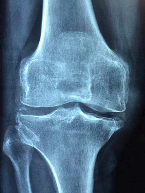 膝盖骨关节炎怎么办？根据病情针对性治疗