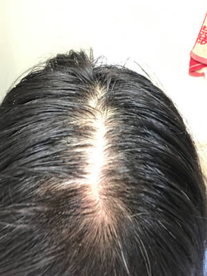怎样治疗脱发和生发？用了达霏欣米诺地尔三个月长出了头发是真得吗？