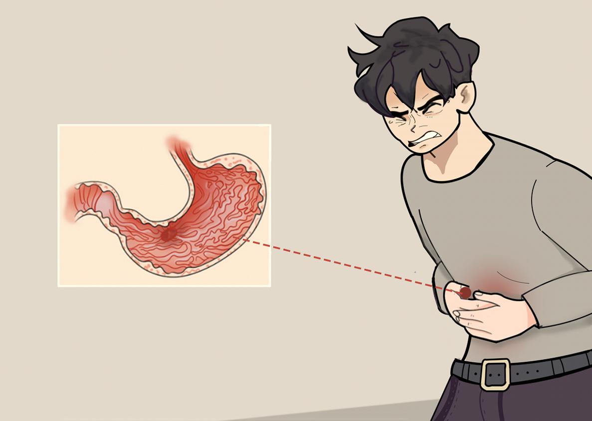 十二指肠溃疡临床表现有哪些，你真的知道吗