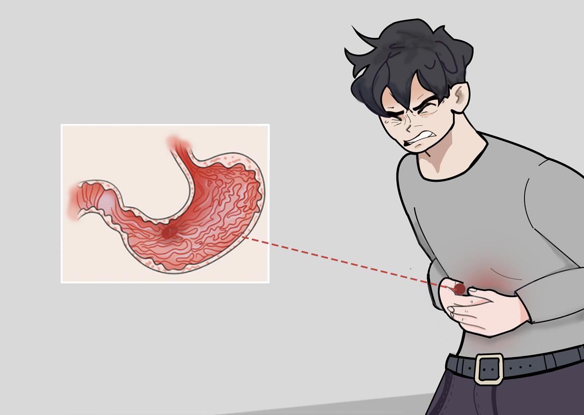胃溃疡怎么治疗？吸烟可要不得！