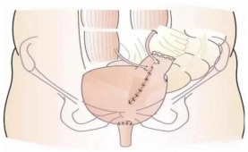 黑龙江省首例达芬奇手术机器人辅助全腔镜下膀胱全切术顺利开展