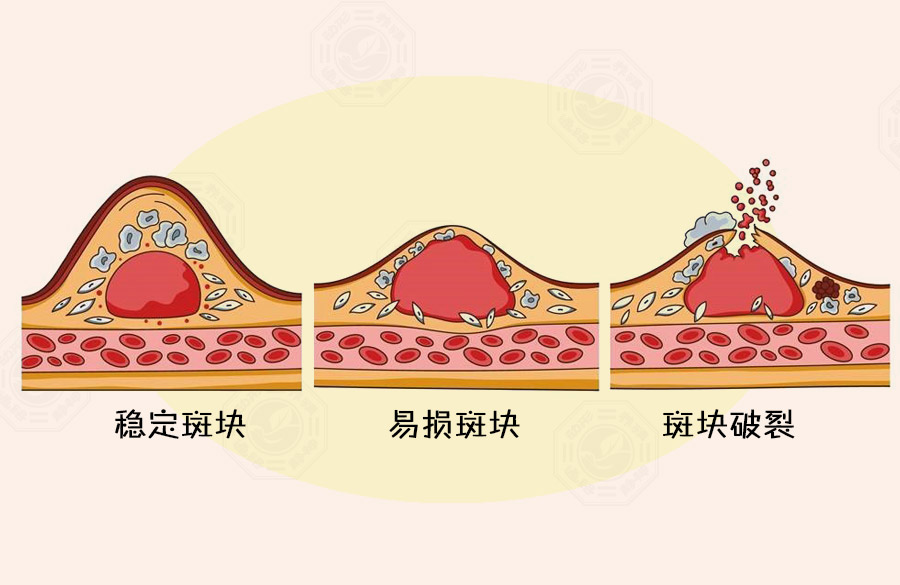 寒潮来袭时，别让心脑血管病找上门