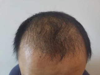 脂溢性脱发如何生发？有什么好办法？