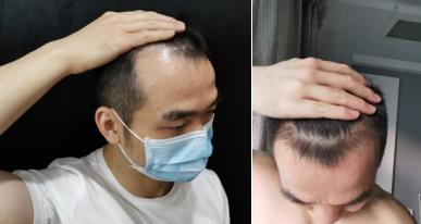 男性脱发的治疗方法是什么？告诉你，用它就够了！