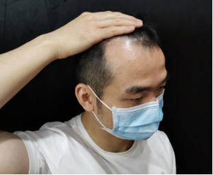 男性脱发的预防护理，现在掌握还不晚！