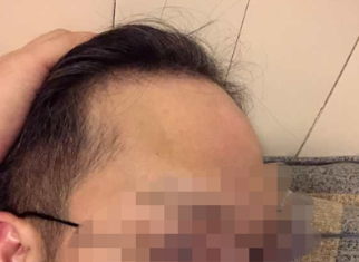 脂溢性脱发能不能治疗？快看看方法用对了吗？
