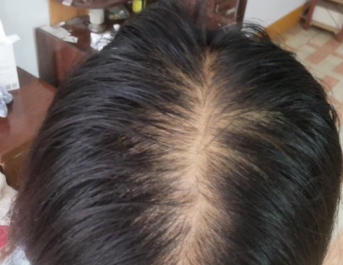 拯救发量，用米诺地尔酊多久能长头发？