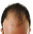 治疗男性脱发的比较好方法，帮你远离脱发烦恼！