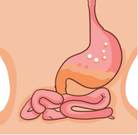 奥美拉唑肠溶胶囊主要治什么胃病？哪些人需要服用呢？