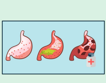 金奥康奥美拉唑治疗胃炎吗？胃炎需要注意哪些？