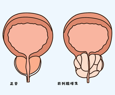 高血压伴前列腺增生吃什么药？保护男性健康用它没错！