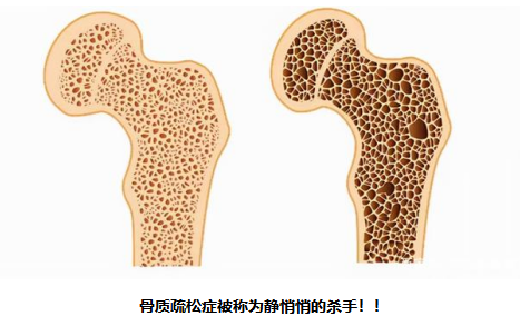 警惕沉默的骨骼杀手——骨质疏松，赶紧行动护骨骼健康！