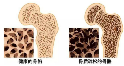 女神节关爱妇女健康，防治骨质疏松享受幸福生活