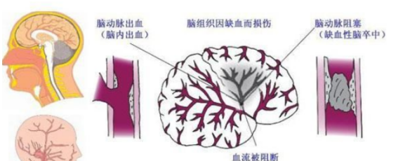 脑卒中并发症有哪些