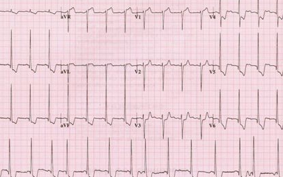 40%～50%急性心肌梗死病人的第一份心电图可以表现不典型或正常